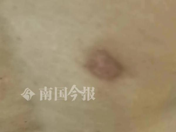 又痒又难受！柳州男子做完养生项目后，麻烦来了……